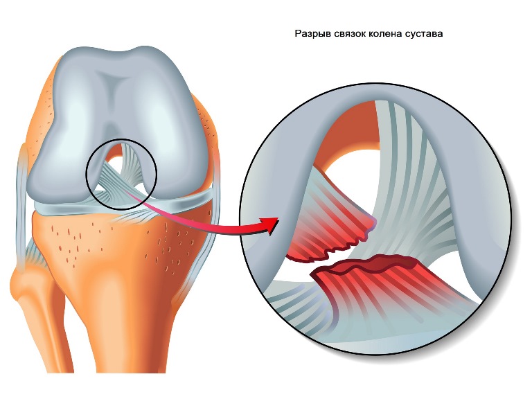 Код мкб 10 гемартроз правого коленного сустава