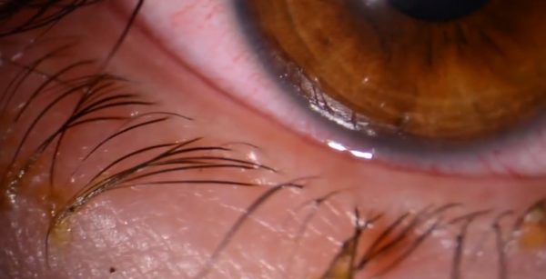 Капли для лечения синдрома сухого глаза капли для глаз