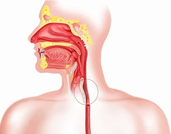 Синдром Бурхаве