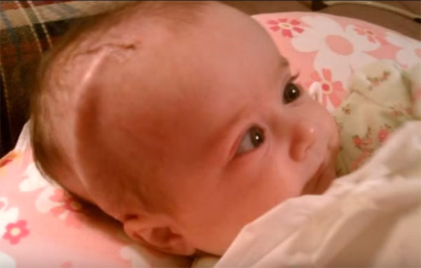 Ребенок с гидроцефалией