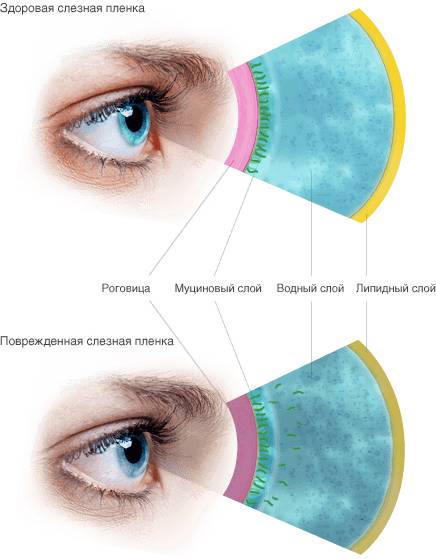 Здоровая и поврежденная слезная пленка Здоровая и поврежденная слезная пленка