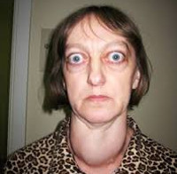 Диффузный токсический зоб Диффузный токсический зоб