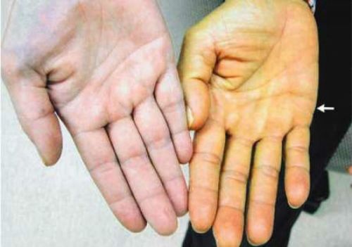 Желтушность кожи