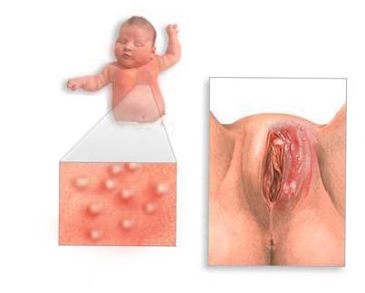 Клинические проявления цитомегаловирусной инфекции