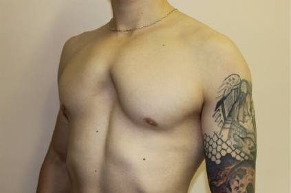 Код мкб воронкообразная грудная клетка