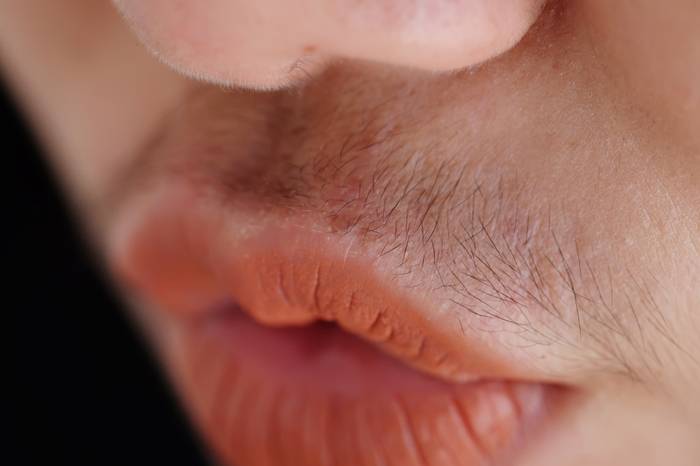 гирсутизм - оволосение по мужскому типу один из симптомов синдрома поликистозных яичников - гирсутизм