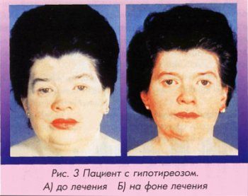 Внешний вид больной гипотиреозом
