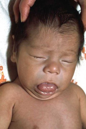 Врожденный гипотиреоз