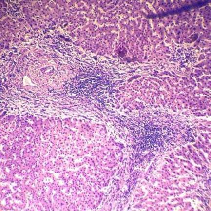 Хронический персистирующий гепатит (гистологический препарат)