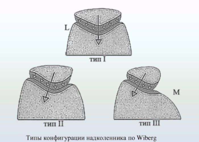 Нестабильность надколенника, наружный подвывих надколенника