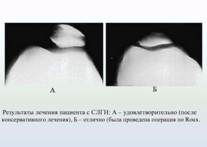 Нестабильность надколенника, наружный подвывих надколенника