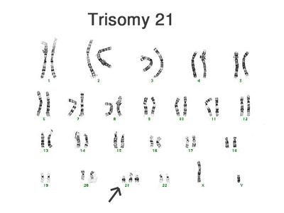 kariotipNa Trisomiyu