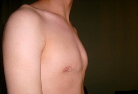 Код мкб воронкообразная грудная клетка