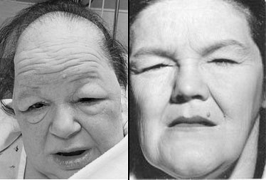 гипотиреоз