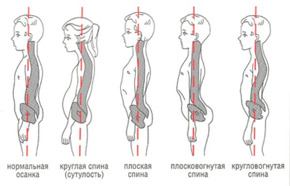 МКБ-10: нарушение осанки нарушение осанки, мкб 10, классификатор