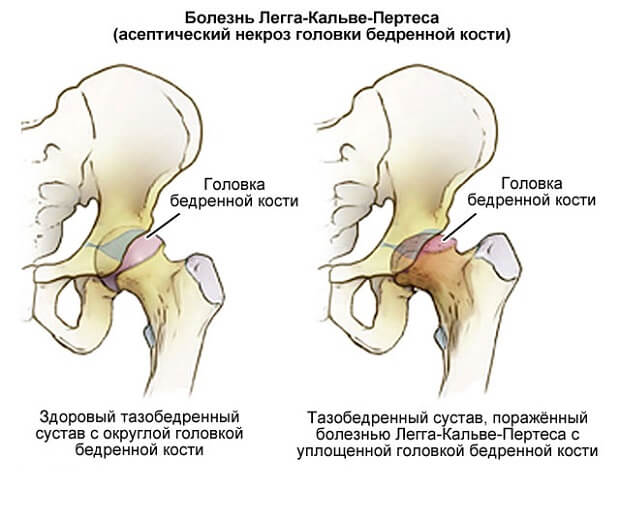 развитие заболевания