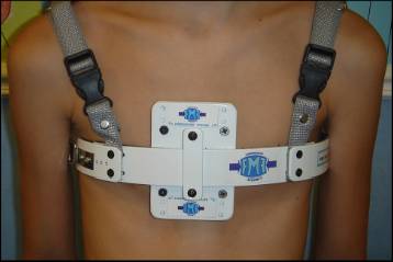 Код мкб воронкообразная грудная клетка