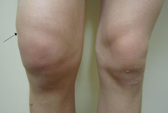 Код мкб 10 гемартроз правого коленного сустава