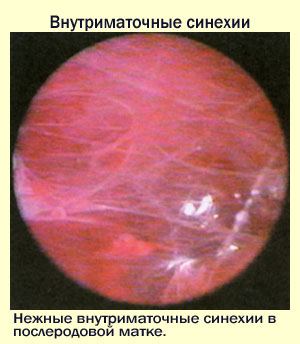 Синдром Ашермана