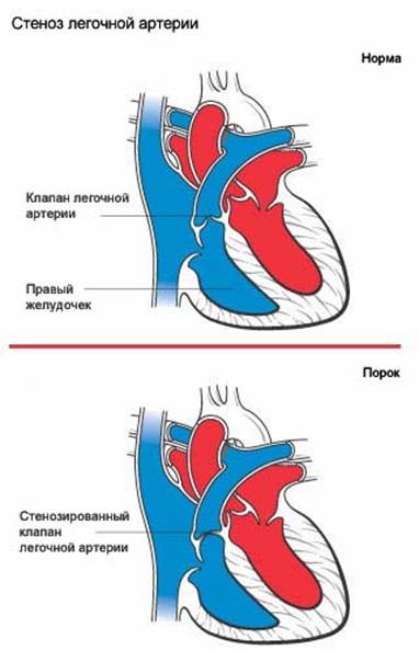 Гемодинамика при стеное устья легочной артерии