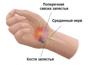 Природа туннельного синдрома запястья