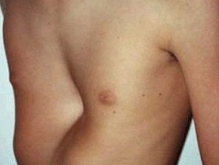 Код мкб воронкообразная грудная клетка